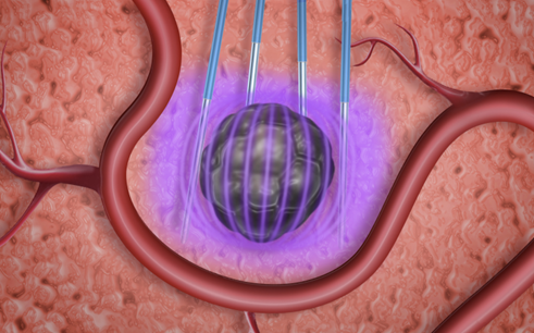 Latest in Ablation - Electroporation of a tumor